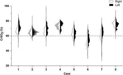 Cerebral Tissue Regional Oxygen Saturation as a Valuable Monitoring Parameter in Pediatric Patients Undergoing Extracorporeal Membrane Oxygenation